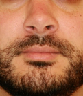Feel Beautiful - Rhinoplasty 215 - After Photo